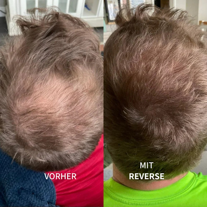 Reverse™ | Haarwuchs Roll-On