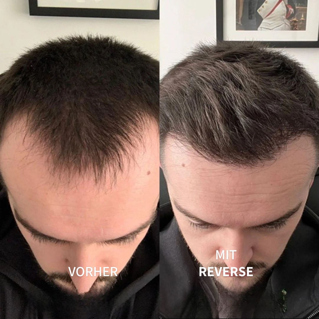 Reverse™ | Haarwuchs Roll-On